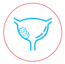 Bladder Cancer